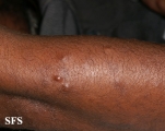 leprosy lepromatous