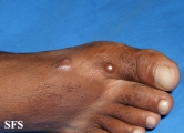 leprosy lepromatous