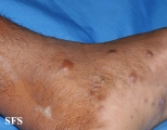 leprosy lepromatous