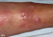 leprosy lepromatous
