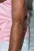 leprosy lepromatous