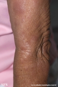 leprosy lepromatous