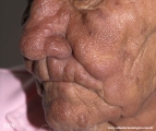 leprosy lepromatous