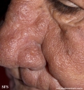 leprosy lepromatous