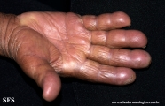 leprosy lepromatous