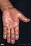 leprosy lepromatous