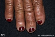 leprosy lepromatous