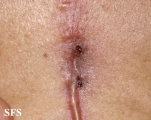 osteomyelitis