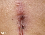 osteomyelitis