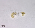 osteomyelitis