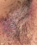 candidiasis