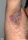 candidiasis