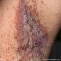 candidiasis