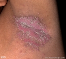 candidiasis