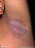 candidiasis