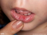 candidiasis