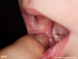 candidiasis