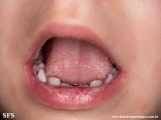 candidiasis