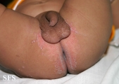 candidiasis