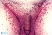 candidiasis