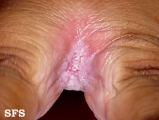 candidiasis