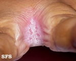candidiasis