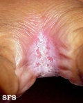 candidiasis