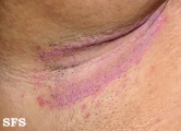 candidiasis