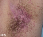 candidiasis