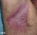 candidiasis