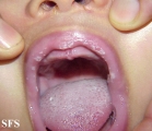 candidiasis