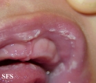 candidiasis