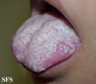 candidiasis