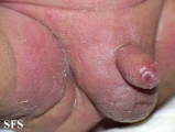 candidiasis