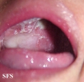 candidiasis