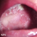 candidiasis