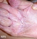 candidiasis