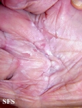 candidiasis