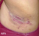 candidiasis