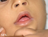 candidiasis