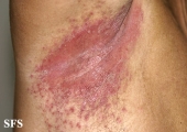 candidiasis