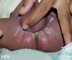 candidiasis