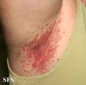 candidiasis