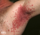 candidiasis
