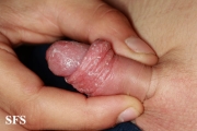 candidiasis