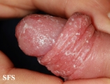 candidiasis