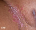 candidiasis