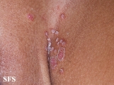 candidiasis