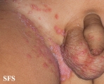 candidiasis