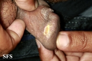 candidiasis